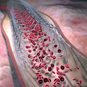 coronary-angioplasty-stenting-375x321